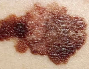 Melanoma